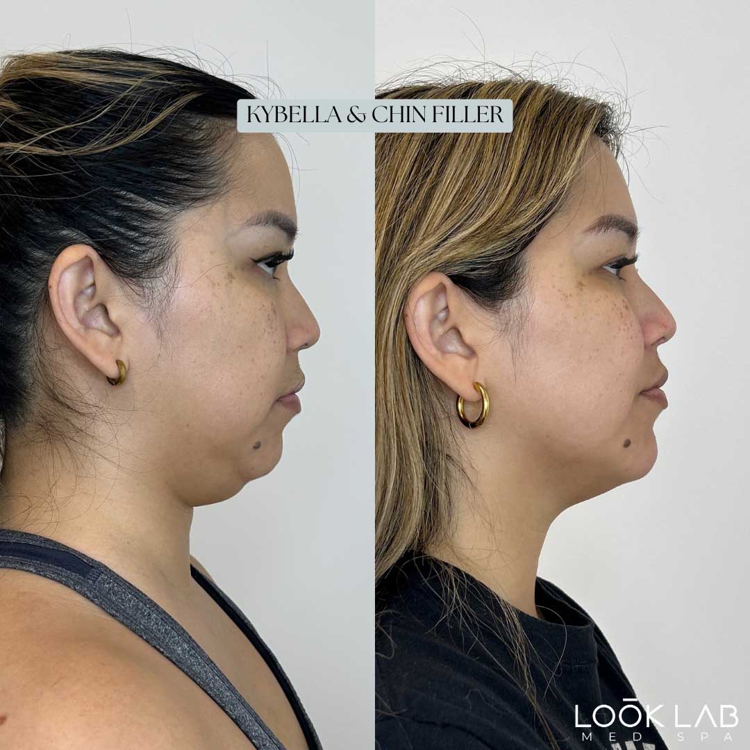 Before and After 30
