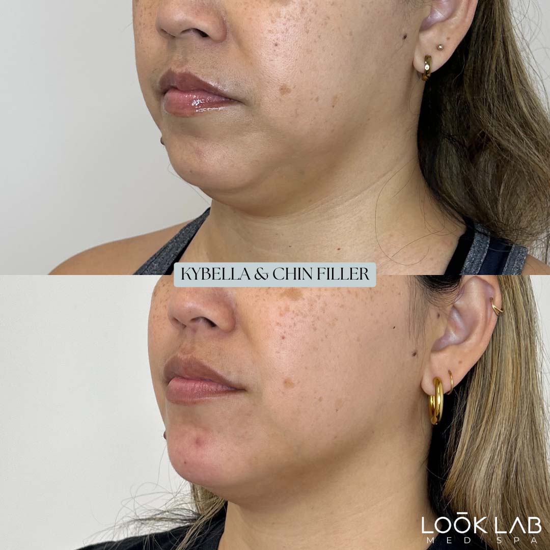 Before and After 32