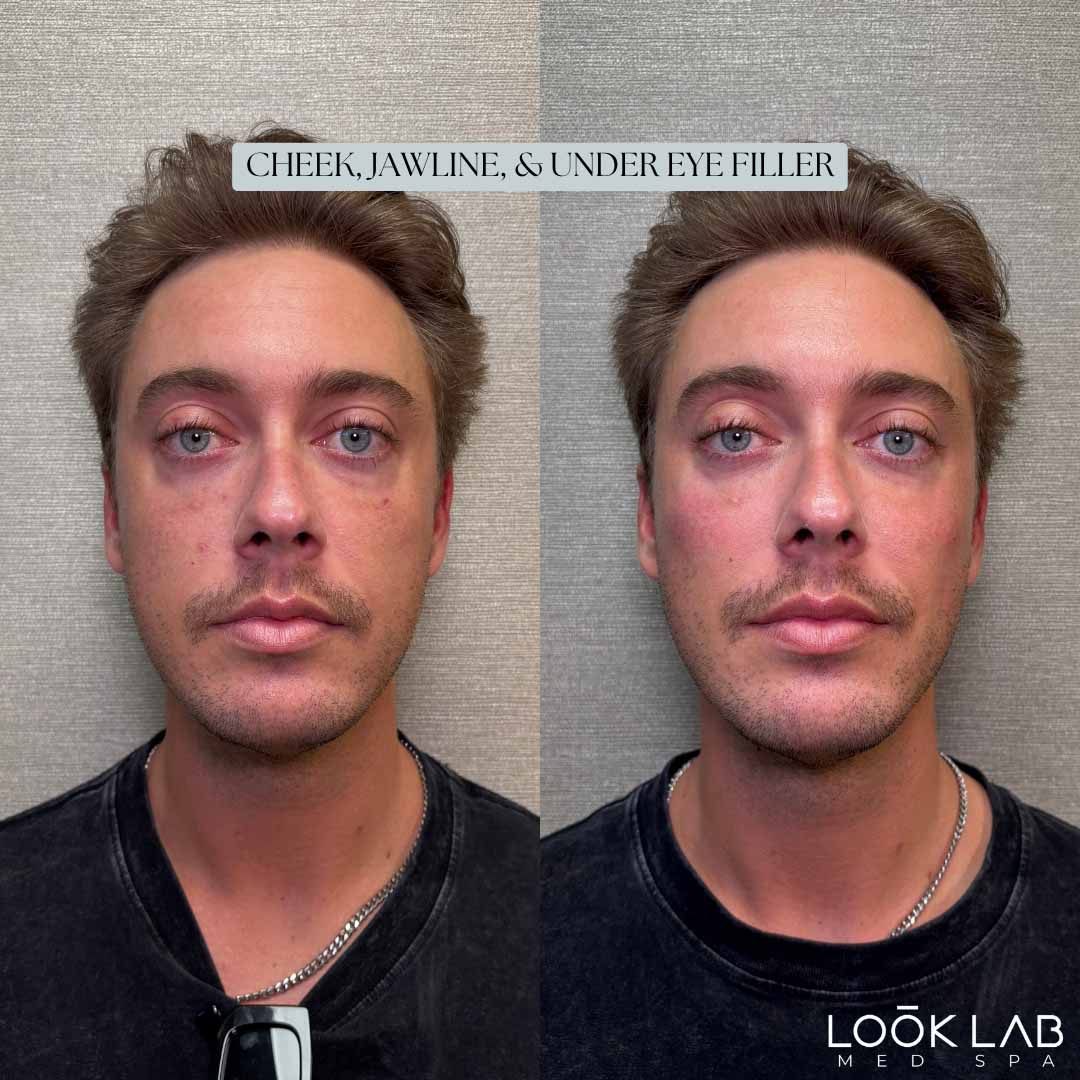 Before and After 44