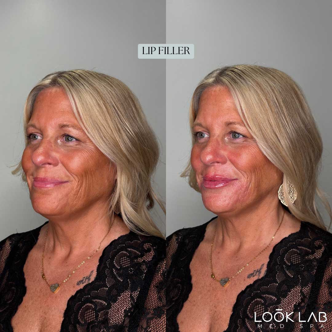 Before and After 45
