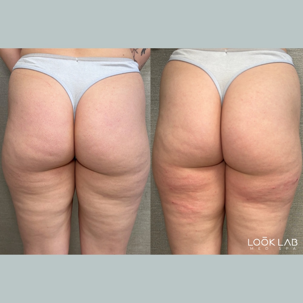 Before and After 1