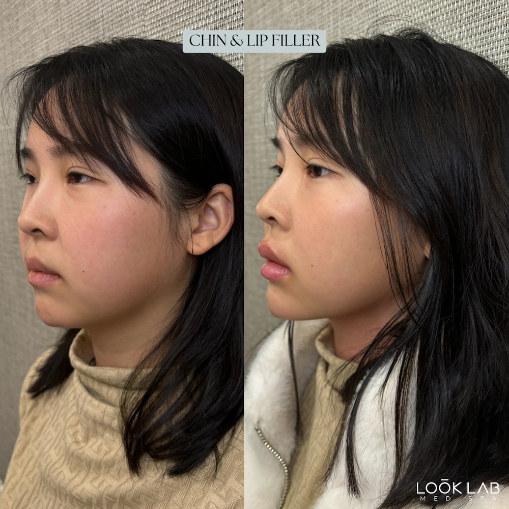 Before and After 25