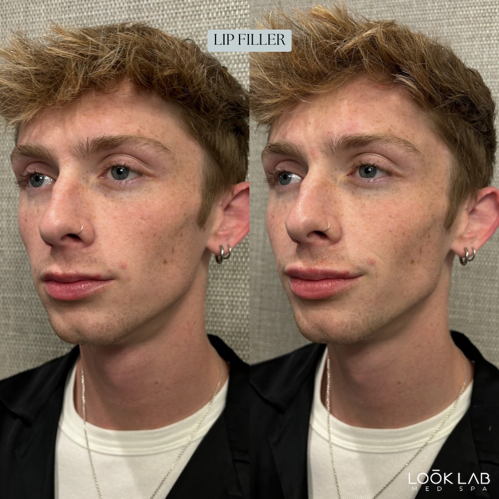 Before and After 15