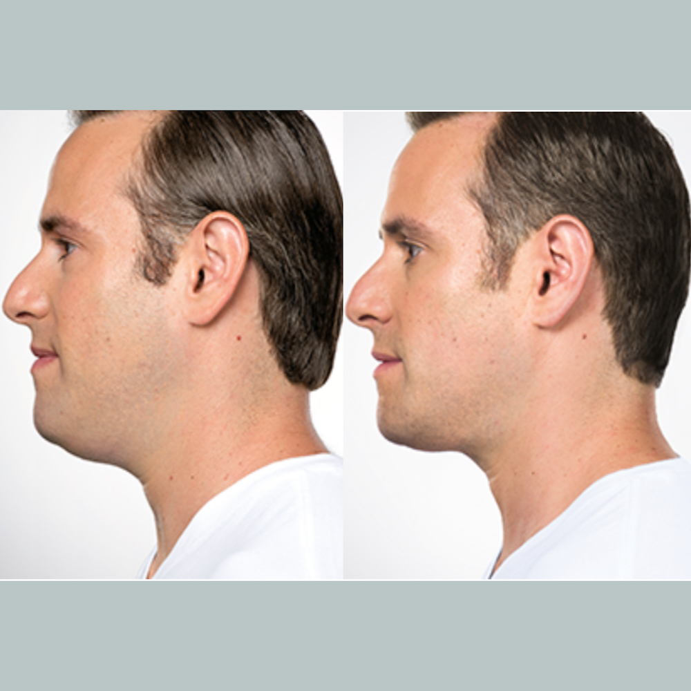 Before and After 6