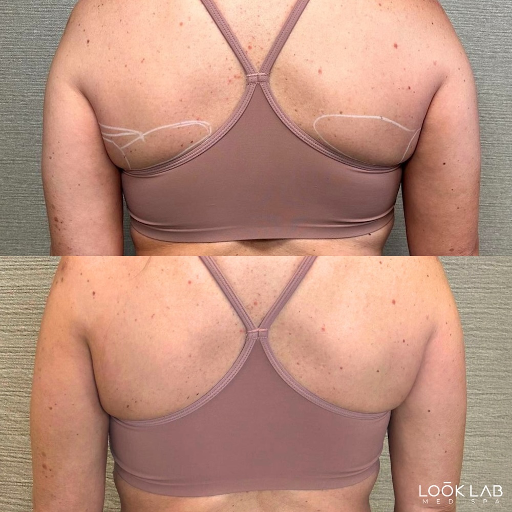 Before and After 1