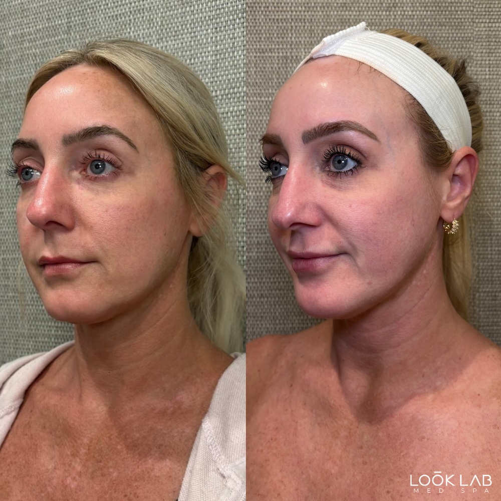 Before and After 2