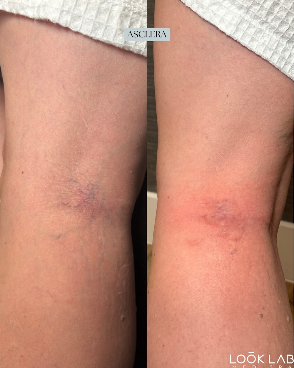 Before and After 1