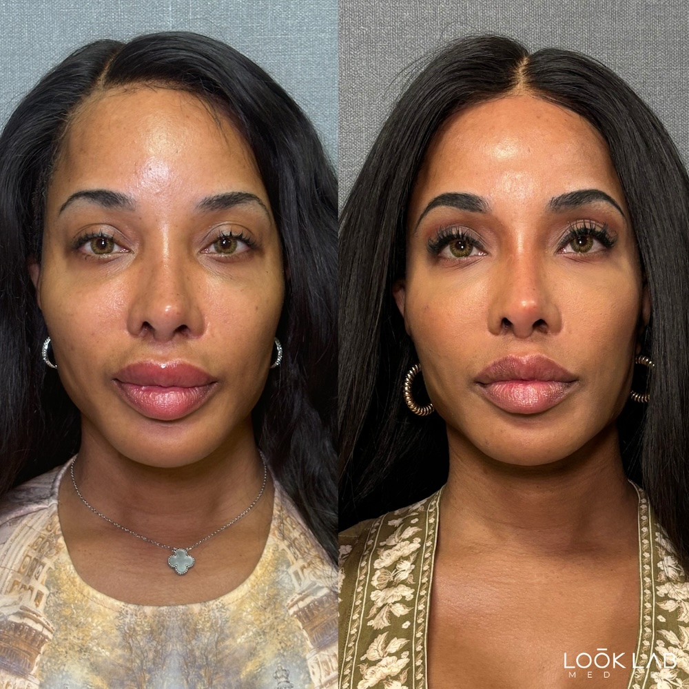 Before and After 4