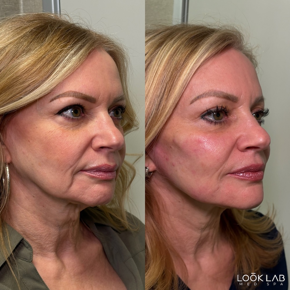 Before and After 1