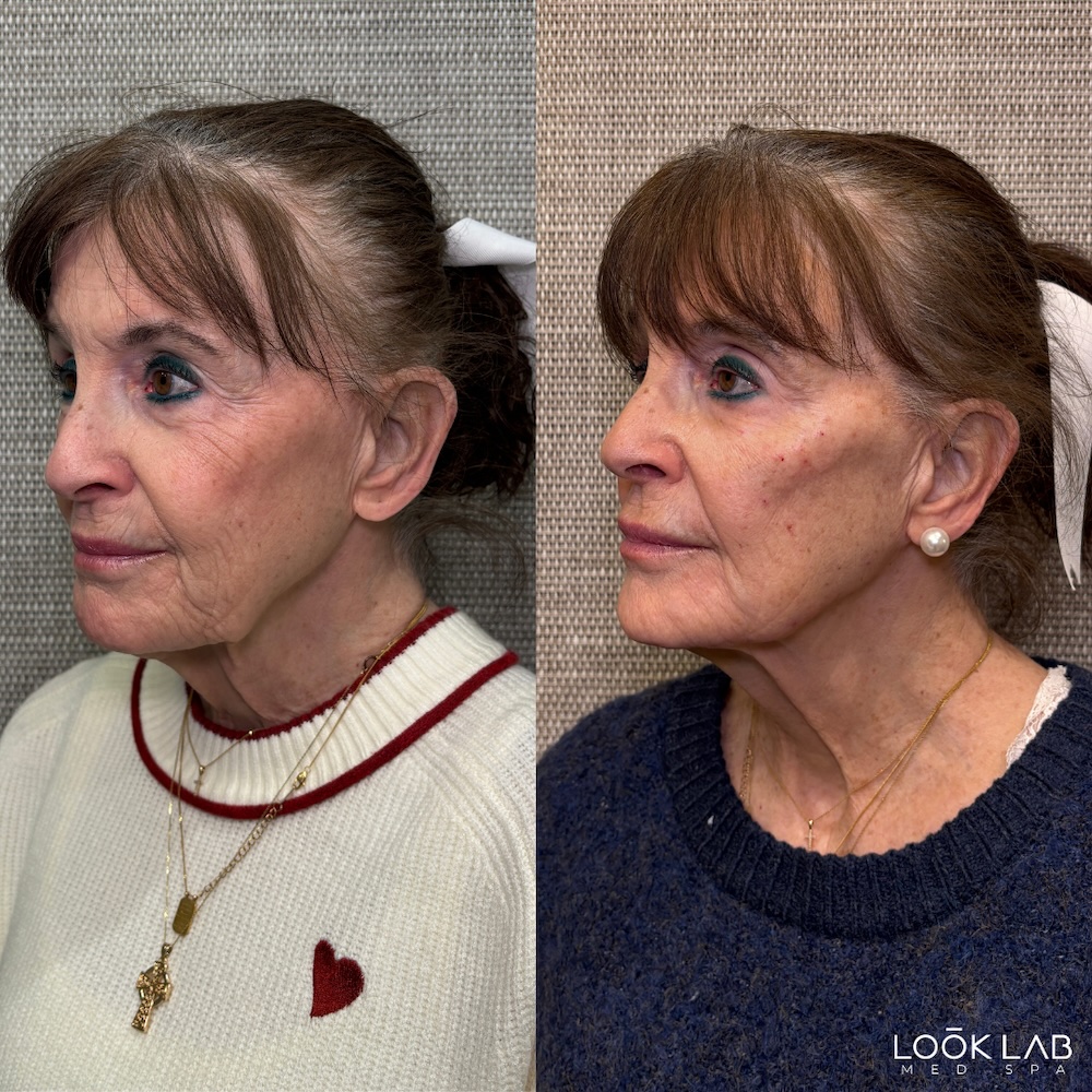 Before and After 2