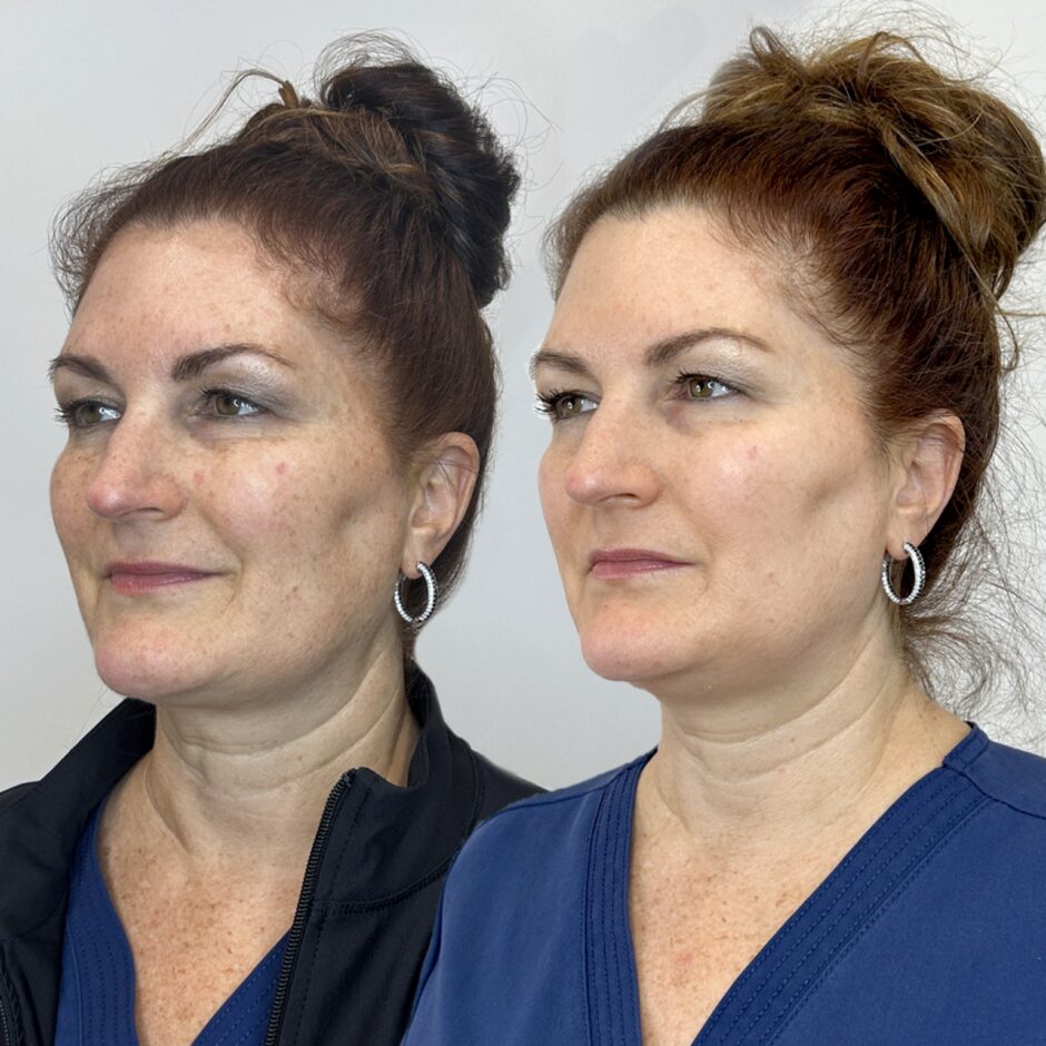 Before and After 2