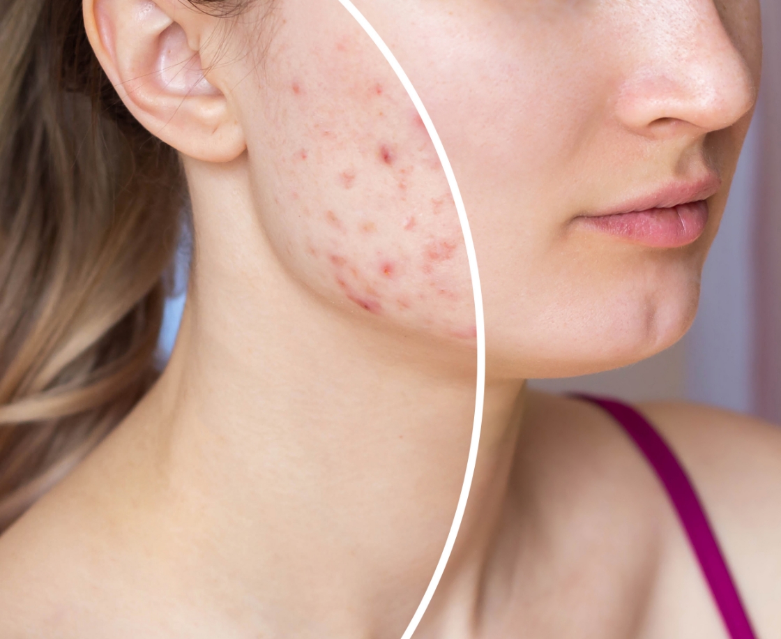 Cystic Acne