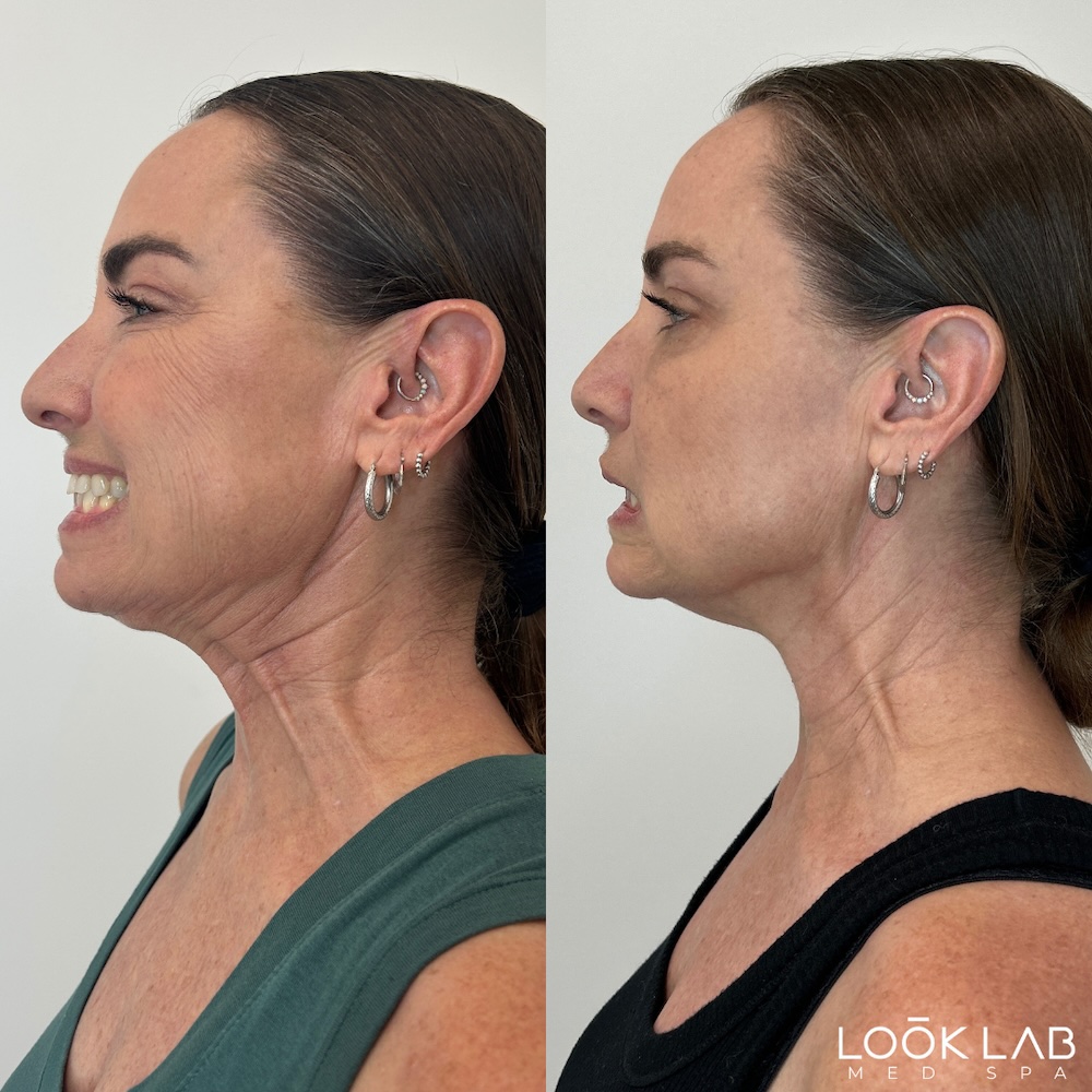 Before and After 14
