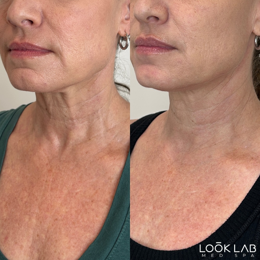 Before and After 15