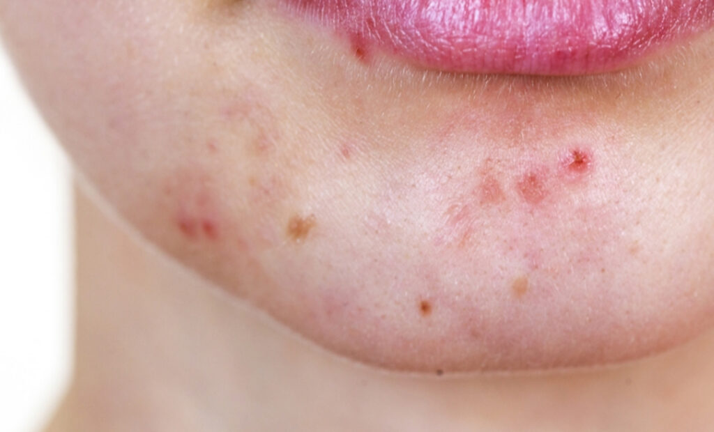 Closeup of a patient's chin showing acne. One of the many benefits of a Hydrafacial in Scottsdale is a reduction in acne appearance and outbreaks. 