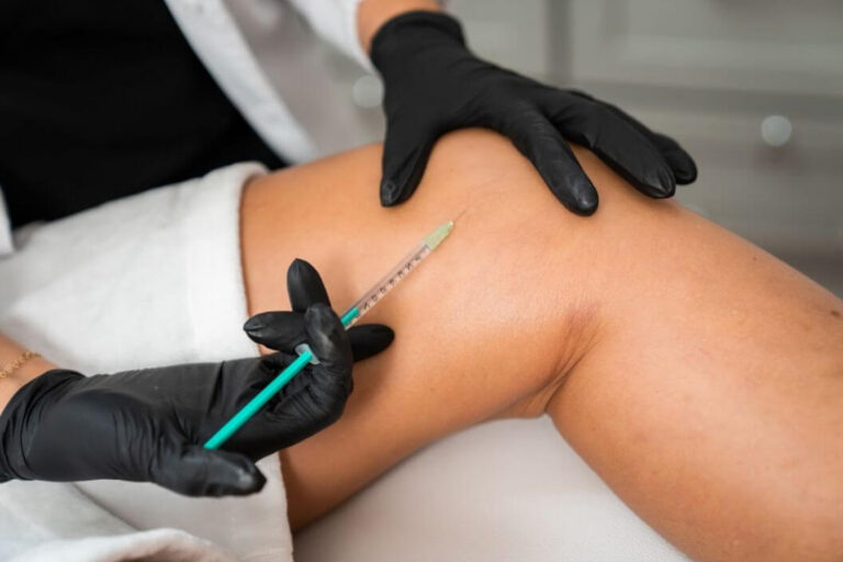 Sclerotherapy Recovery: Tips for Faster Healing